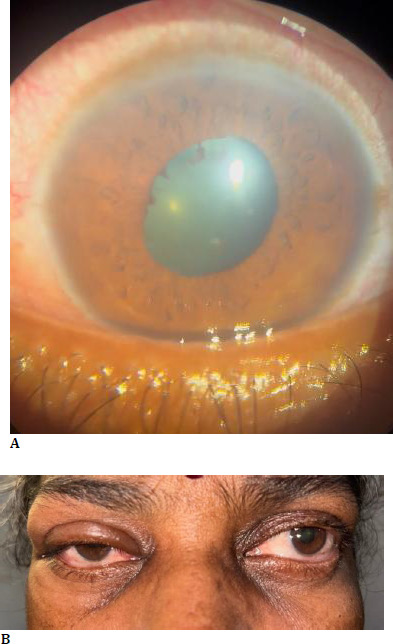 Ibandronic Acid Induced Orbital Inflammation and Concurrent Anterior Uveitis - A Rare Presentation.