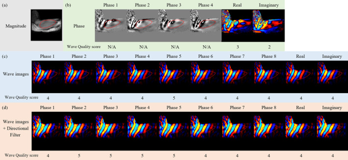 Magnetic Resonance Elastography of Upper Trapezius Muscle.