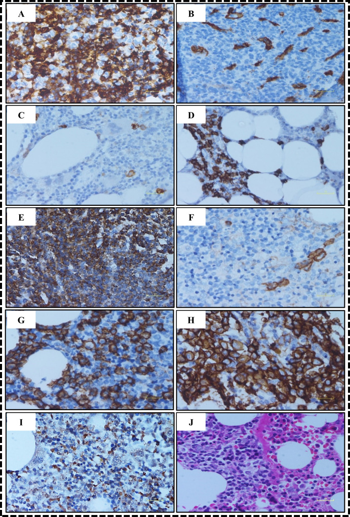 Prognostic implications of MUC1 and XBP1 concordant expression in multiple myeloma: A retrospective study.