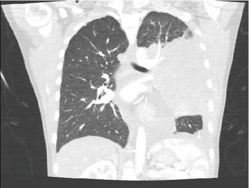 Insidious Primary Mediastinal Large B-Cell Lymphoma in a Young Female: A Case Report and Literature Review.