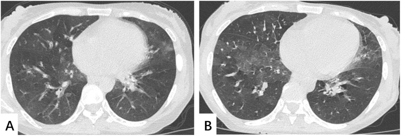 Eosinophilic Granulomatous Polyangiitis with Autoimmune Hemolytic Anemia: A Case Report and Review of the Literature.