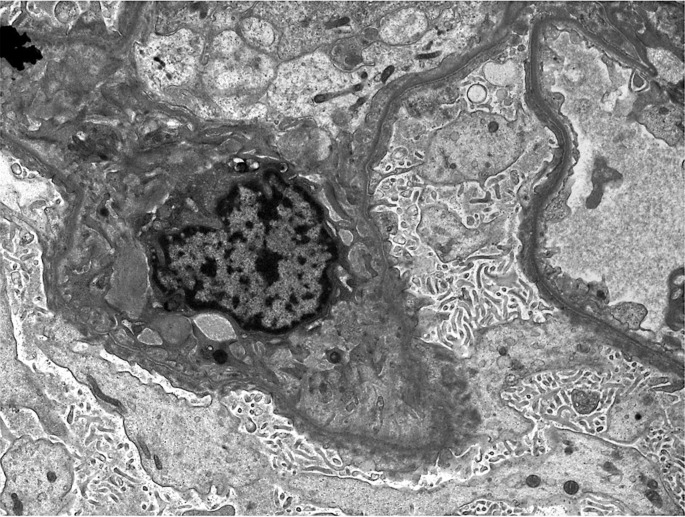 Rare Association between Minimal Change Disease and Primary Biliary Cholangitis: Case Report.