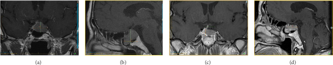 Thyroid-Stimulating Hormone-Secreting Pituitary Adenoma: Two Cases With Challenging Diagnosis and Management.