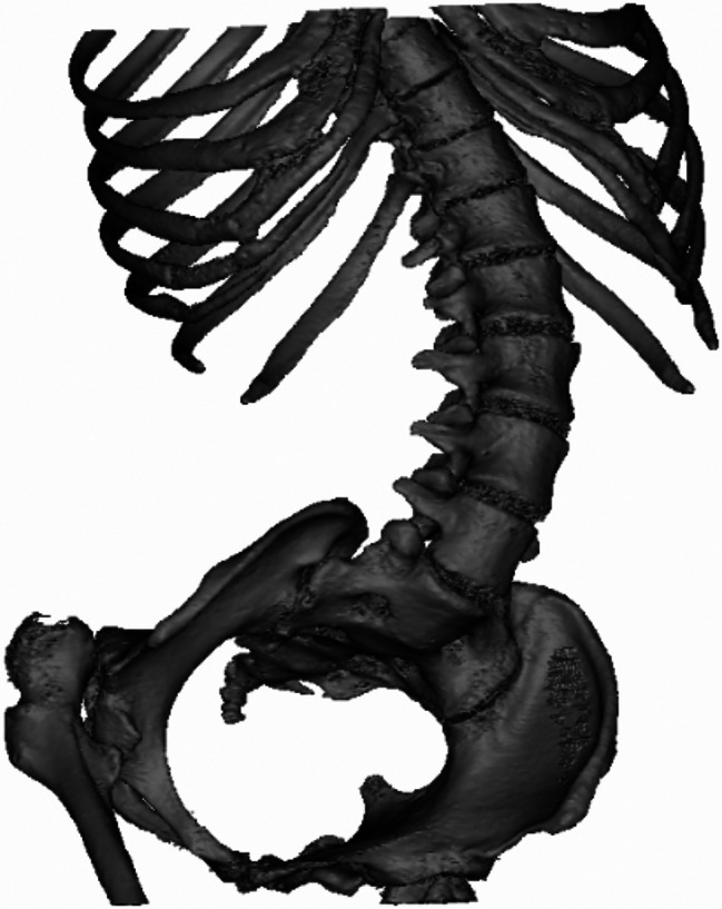 Utilization of 3D printing modeling techniques in the simulation instruction of ultrasound-guided puncture procedures on scoliotic spines of spinal muscular atrophy.