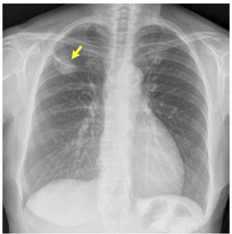 [Triple synchronous primary lung adenocarcinoma: A diagnostic challenge].