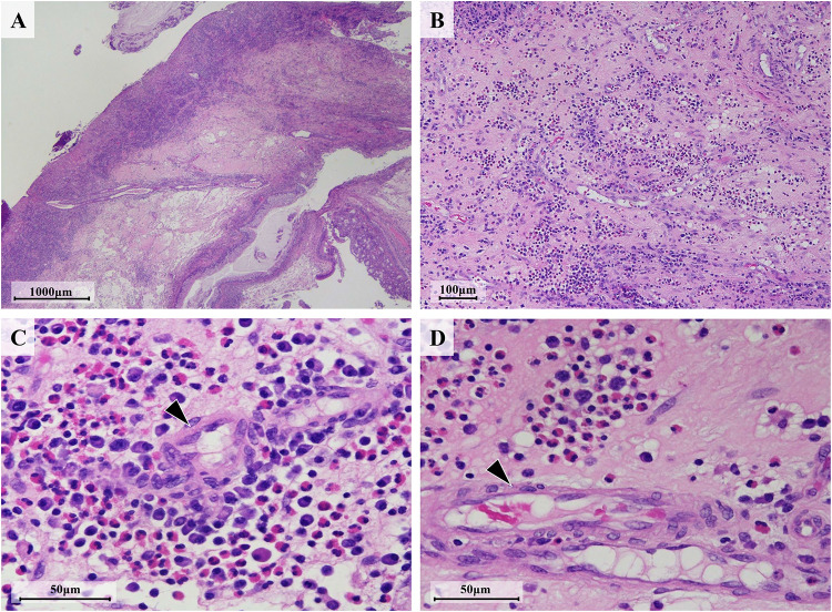 Early Intervention with Mepolizumab, Corticosteroids, and Intravenous Immunoglobulin for Dupilumab-Triggered Eosinophilic Granulomatosis with Polyangiitis: A Case Report.