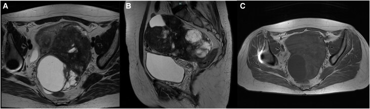 Hypertension and Carcinoid Heart Disease as Initial Manifestations of Ovarian Carcinoid Tumor.