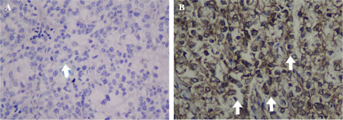 Comparison of PD-L1, CTR-1, VEGF, and p53 expression in sensitive and resistant epithelial ovarian cancer (EOC) patients to platinum-based chemotherapy.