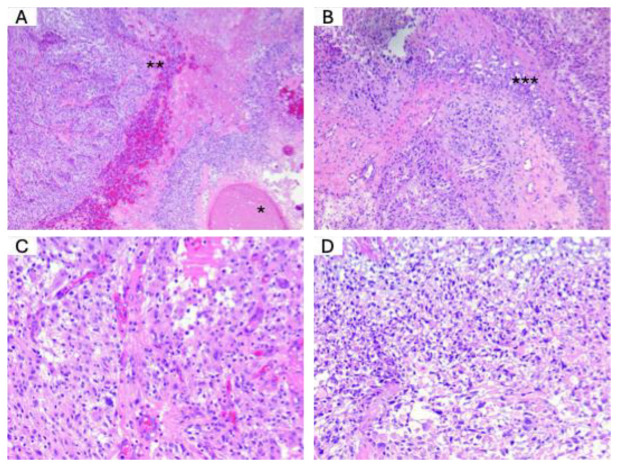 ATRX, OLIG2, MGMT, and IDH2 in Glioblastoma: Essential Molecular Mechanisms and Therapeutic Significance.