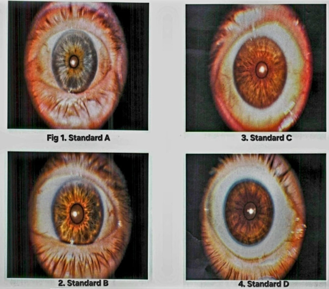 Exploring the relationship between the density of the iris color and bipolar disorder: a case-control study, Egypt.