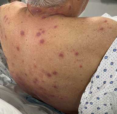 A Not-So-Sweet Crohn's Disease: A Case Report of Ileocecal Crohn's Disease Unmasked by Sweet Syndrome.