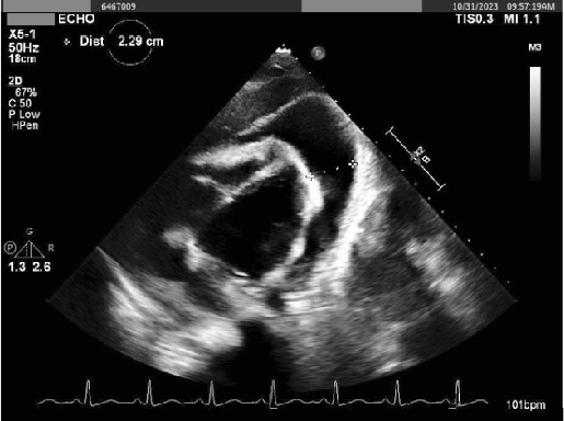 Insidious Primary Mediastinal Large B-Cell Lymphoma in a Young Female: A Case Report and Literature Review.