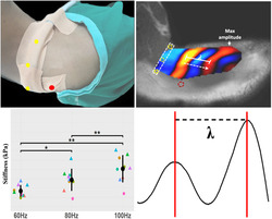 Magnetic Resonance Elastography of Upper Trapezius Muscle.