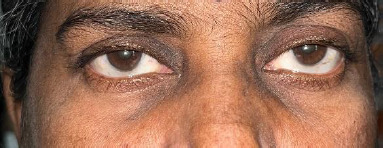 Ibandronic Acid Induced Orbital Inflammation and Concurrent Anterior Uveitis - A Rare Presentation.