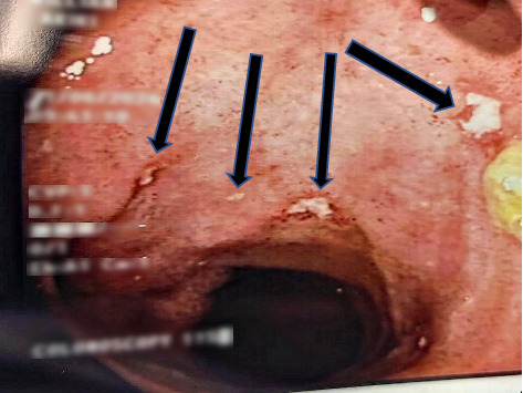 A Not-So-Sweet Crohn's Disease: A Case Report of Ileocecal Crohn's Disease Unmasked by Sweet Syndrome.