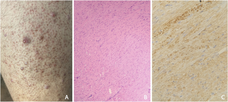 Timely recognition of a probably life-threatening genodermatosis: familial case report of hereditary leiomyomatosis and renal cell cancer.
