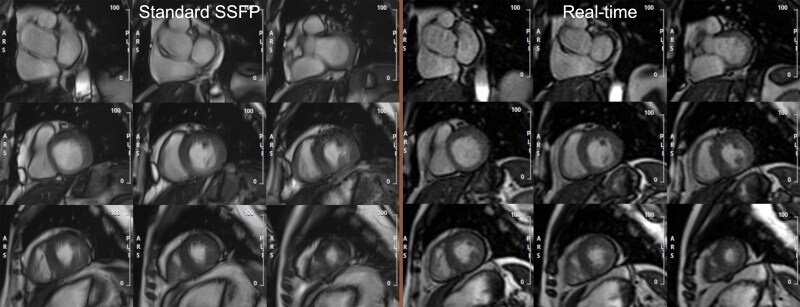 Standard breath-hold versus free-breathing real-time cine cardiac MRI-a prospective randomized comparison in patients with known or suspected cardiac disease.