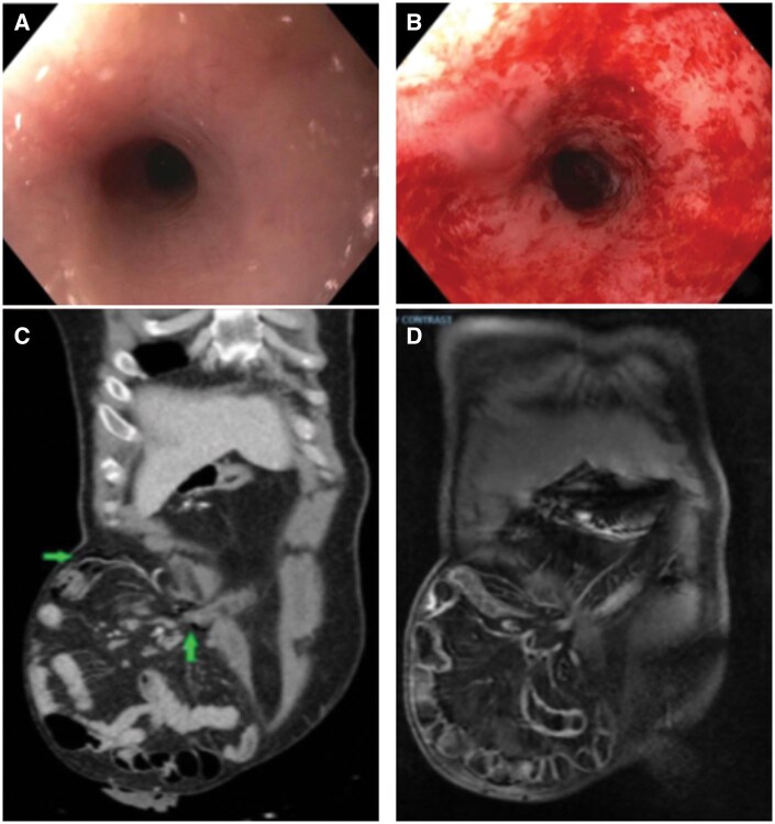 Endoscopic gas leak in diverted colon mimics perforation.
