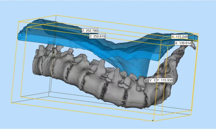 Utilization of 3D printing modeling techniques in the simulation instruction of ultrasound-guided puncture procedures on scoliotic spines of spinal muscular atrophy.