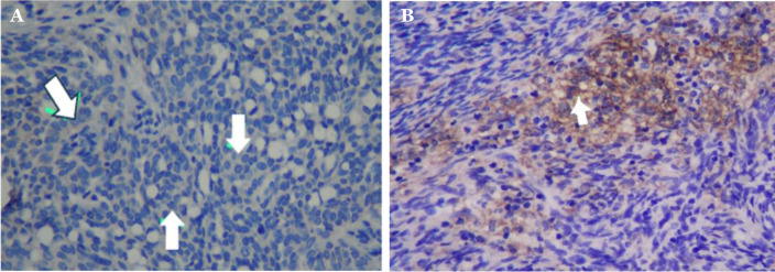 Comparison of PD-L1, CTR-1, VEGF, and p53 expression in sensitive and resistant epithelial ovarian cancer (EOC) patients to platinum-based chemotherapy.