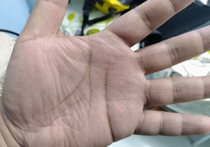 Challenges in diagnosing occupational allergic contact dermatitis: a case report.