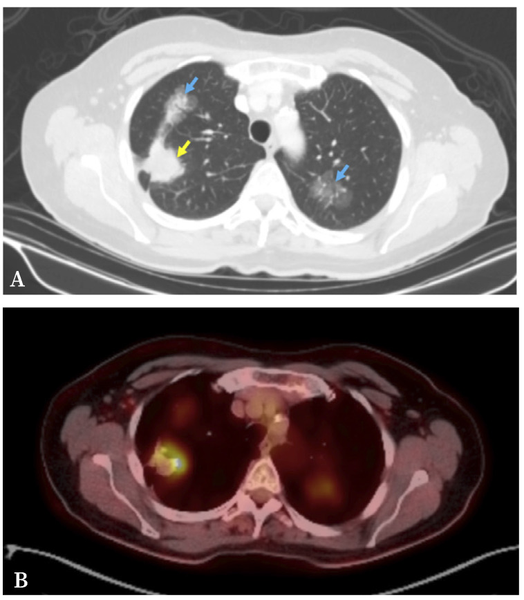 [Triple synchronous primary lung adenocarcinoma: A diagnostic challenge].