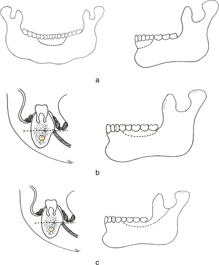 Marginal Mandibulectomy in Oral Cavity Cancers - Classification and Indications.