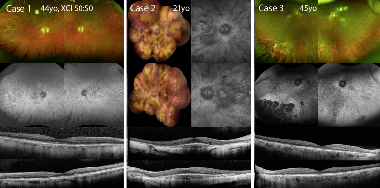 Female Simplex Carriers of X-Linked Retinal Dystrophies: A Case Series.