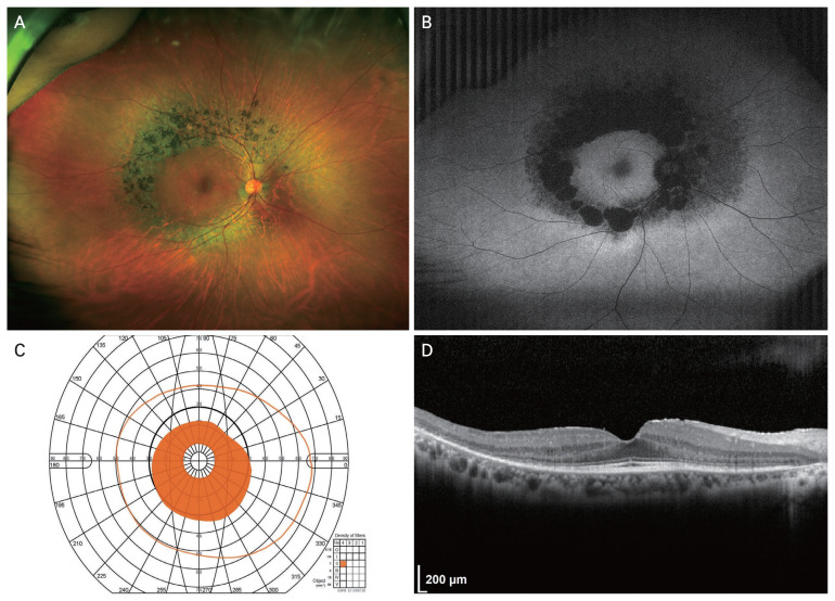 Clinical Characteristics and Visual Prognostic Biomarkers in Pericentral Retinitis Pigmentosa: A Study in a South Korean Cohort.