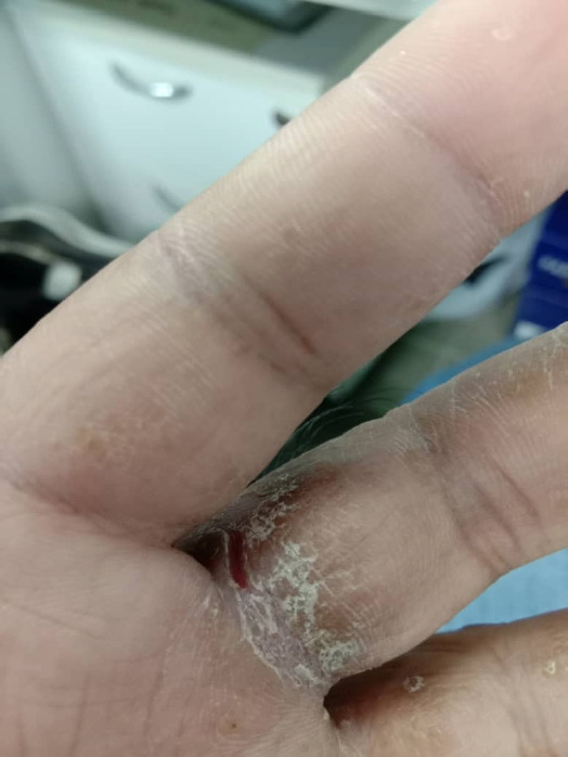 Challenges in diagnosing occupational allergic contact dermatitis: a case report.