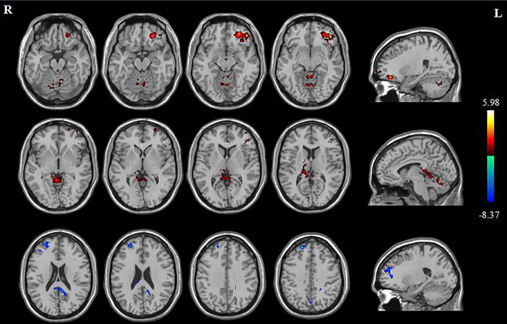 Transcranial Magnetic Stimulation Induces White Matter Microstructure Alterations in Patients with Mild Cognitive Impairment.