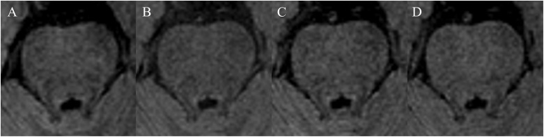 Comparison of 3D Magnetization-transfer- and Spectral-presaturation-with-inversion-recovery-based Neuromelanin Imaging.