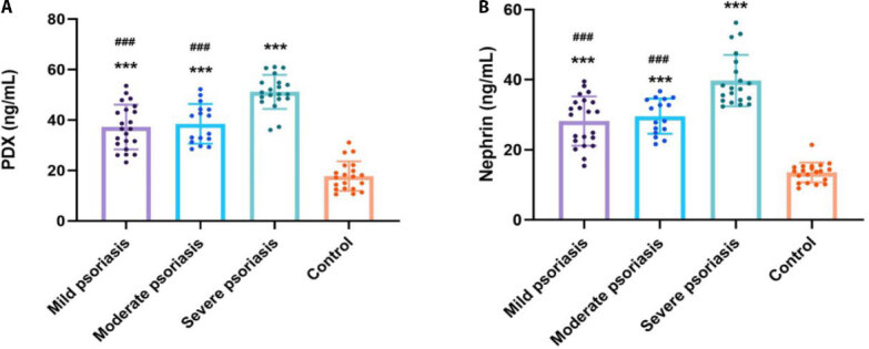 Renal Implications of Psoriasis: Urinary Podocyte Markers and Disease Progression.
