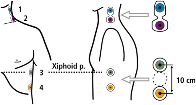 A comparative study on the hemodynamic effects of initiating positive airway pressure treatment in patients with obstructive and central sleep apnea.