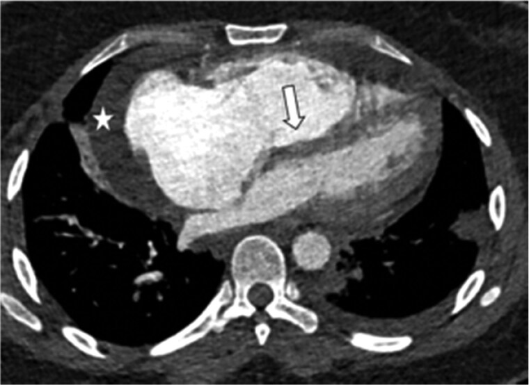 Non-invasive imaging in acute and chronic pulmonary embolism.