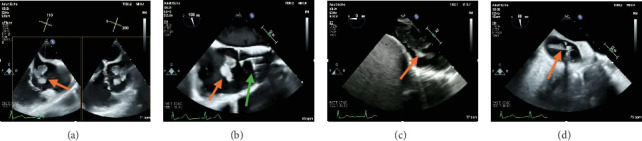 Repeat AngioVac Debulking of a Large Right Atrial Thrombus With Extension From the Hepatic Vein.