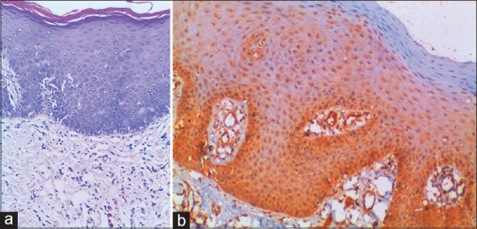 Fibulin-4 expression in potentially malignant disorders and squamous cell carcinoma of oral mucosa-An immunohistochemical study.