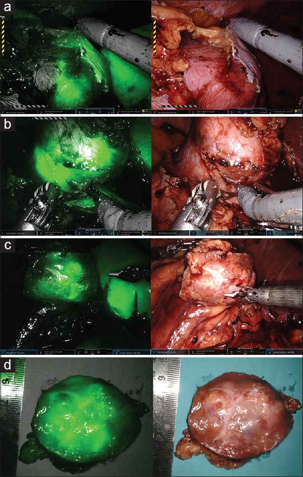 A novel method of using indocyanine green fluorescence technique for nephron-sparing surgery.