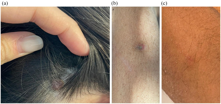 Pilomatricomas in a patient with Rubinstein-Taybi syndrome: diagnostic and therapeutic clues.