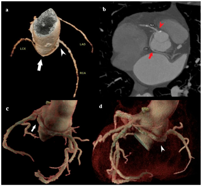 The Role of MDCT Coronary Angiography in the Detection of Benign Varieties and Anomalies of Coronary Blood Vessels-A Narrative Review.