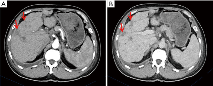 PIK3CA inhibitor treatment for metastatic scrotal extramammary Paget's disease: a case report and literature review.