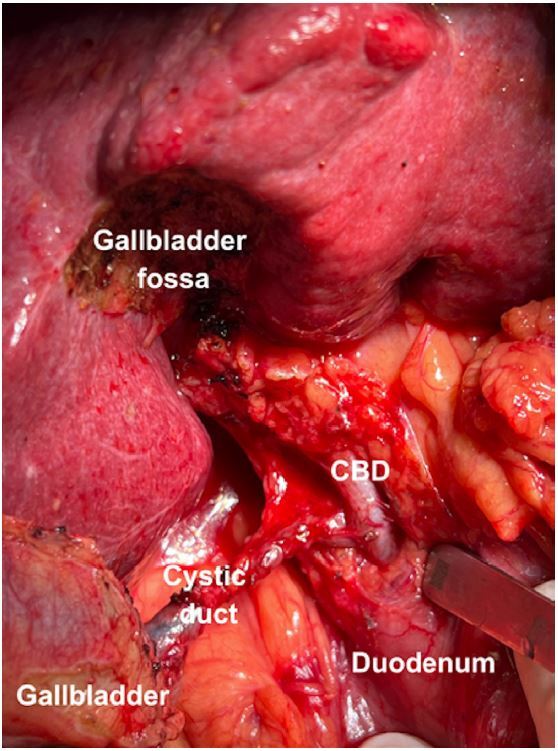 STANDARDIZATION OF THE WHITE TEST IN OPEN LIVER RESECTION: TOWARD NEAR-ZERO CLINICALLY SIGNIFICANT BILE LEAKAGE.