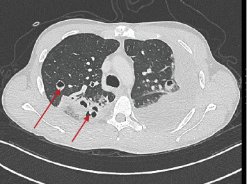 A Subtle Presentation of Pharyngitis and Pneumonia: Lemierre Syndrome.