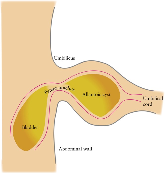 Pop-off mechanisms in fetal megacystis: extravasation, umbilical cord cyst, ureterocele and megaureter.