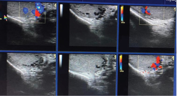 Regional distribution of intratesticular varicoceles accompanying extratesticular varicocele cases.