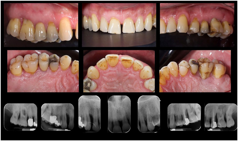 Periodontal Disease and Age-Related Maculopathy: A Case Report.
