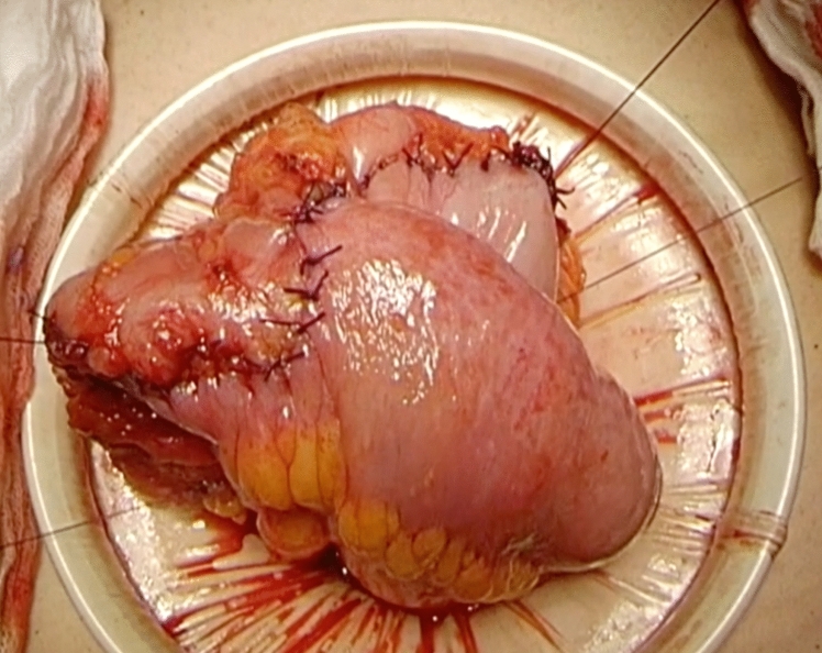 First description of endoscopic dilation of stricturing Kono-S anastomosis in Crohn's disease.