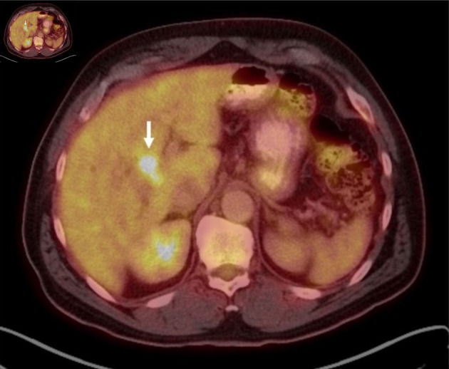 Solitary Synchronous Biliary Metastasis in Colorectal Adenocarcinoma.