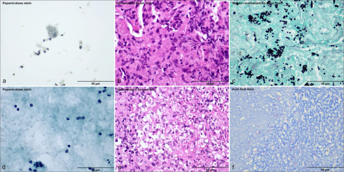 Diagnostic agreement between bronchoalveolar lavage and transbronchial lung biopsy in patients with suspected pulmonary diseases: A single-center study.