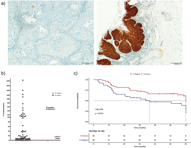Intratumoral <i>Fusobacterium nucleatum</i> is associated with better cancer-specific survival in head and neck cancer patients.